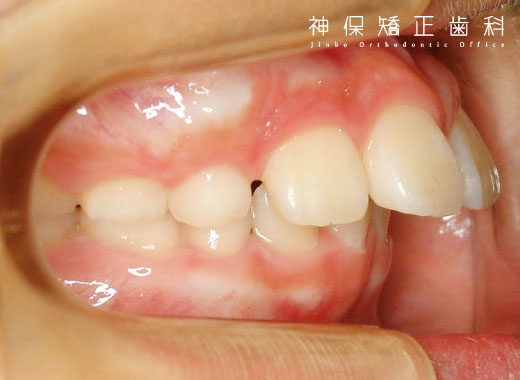 上顎前突症（じょうがくぜんとつしょう）子ども
