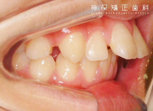 上顎前突症（じょうがくぜんとつしょう）子ども