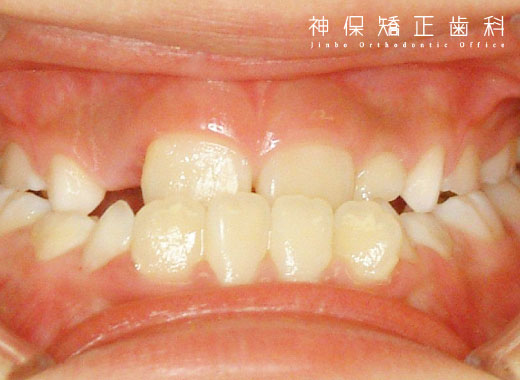 下顎前突症（かがくぜんとつしょう）子ども